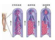靜脈血栓是如何一步步危及人生命的?