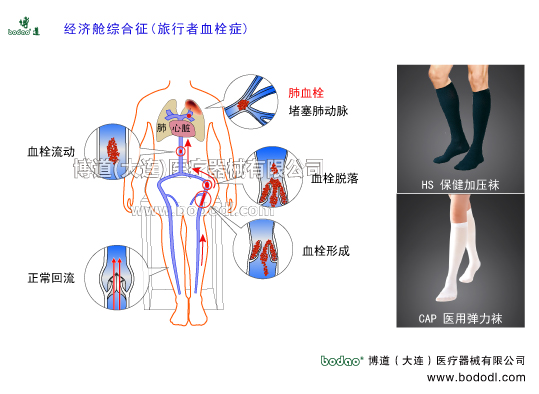 深靜脈血栓形成的預(yù)防與護(hù)理