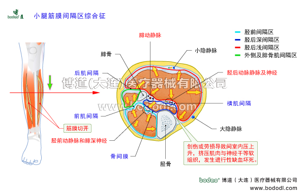 深靜脈血栓形成的預(yù)防與護(hù)理