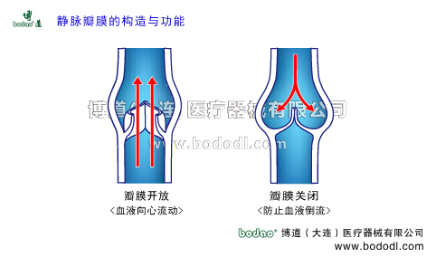靜脈曲張的預(yù)防與治療