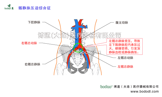靜脈曲張的預(yù)防與治療