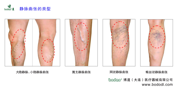 靜脈曲張的預(yù)防與治療