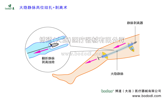靜脈曲張的預(yù)防與治療