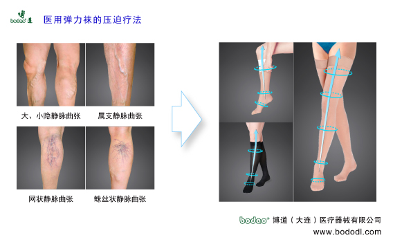 靜脈曲張的預(yù)防與治療