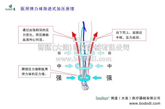 靜脈曲張的預(yù)防與治療