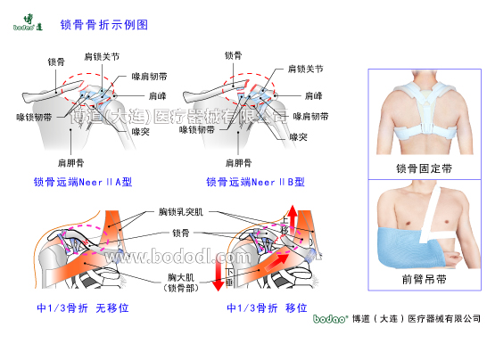 鎖骨的常見傷病與健康防護(hù)