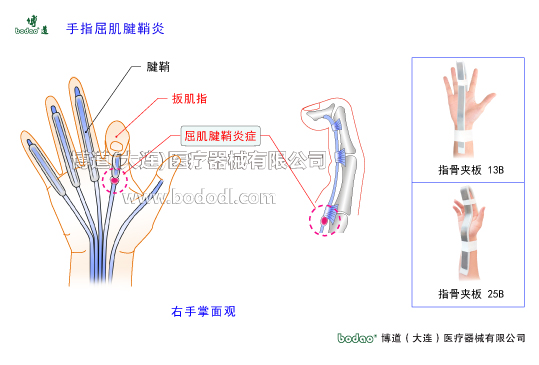 手關(guān)節(jié)常見傷病與健康防護(hù)