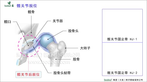 髖關(guān)節(jié)疾病與健康護理