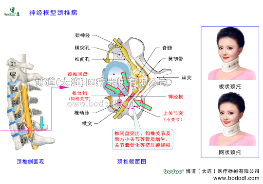 神經(jīng)根型頸椎病的病因、癥狀及防護(hù)治療，頸椎病的種類，頸椎綜合癥的治療與康復(fù)護(hù)理，神經(jīng)根型頸椎病的預(yù)防與治療博道透氣頸托頸椎固定帶頸椎間盤突出矯正支架鉤椎關(guān)節(jié)和頸椎小關(guān)節(jié)骨質(zhì)增生勞損骨刺形成小關(guān)節(jié)囊骨化鈣化關(guān)節(jié)突關(guān)節(jié)不穩(wěn)頸椎退行性病頸椎創(chuàng)傷性關(guān)節(jié)炎椎間孔狹小擠壓神經(jīng)根頸椎解剖構(gòu)造圖頸椎的構(gòu)造圍領(lǐng)護(hù)頸高度可調(diào)式頸椎固定支具頸椎骨折急救頸托頸神經(jīng)節(jié)椎動(dòng)脈椎