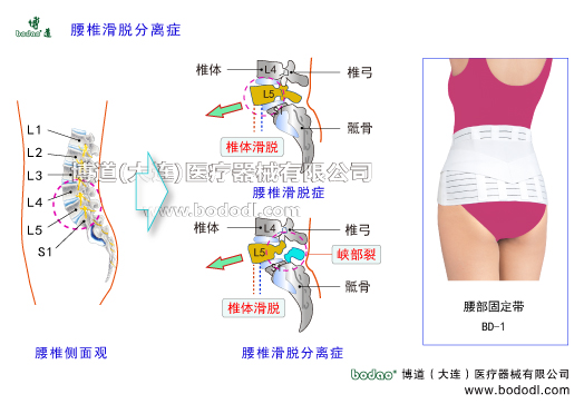 腰椎滑脫癥腰椎分離癥腰椎峽部裂腰椎滑脫分離癥腰椎峽部不連腰椎滑脫分離的主要癥狀與治療博道腰部固定帶醫(yī)用護(hù)腰腰椎軟骨退行性病變腰椎積累性損傷椎間孔狹窄壓迫神經(jīng)根坐骨神經(jīng)炎腰椎間盤突出癥髓核破裂椎弓椎體骶骨椎管神經(jīng)根脊神經(jīng)節(jié)前縱韌帶后縱韌帶椎間關(guān)節(jié)馬尾綜合征關(guān)節(jié)突關(guān)節(jié)變形腰肌勞損腰背肌筋膜炎腰骶部慢性損傷閃腰急性腰扭傷腰椎的結(jié)構(gòu)解剖腰骶關(guān)節(jié)勞損骶髂關(guān)節(jié)炎馬尾綜合癥腰椎固定帶腰圍第四第五腰椎滑脫第一骶椎博
