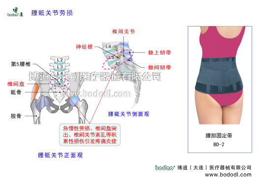 腰骶關(guān)節(jié)勞損腰骶關(guān)節(jié)炎的癥狀與治療腰骶關(guān)節(jié)在哪里腰骶關(guān)節(jié)形成角度120°是活動性腰椎轉(zhuǎn)變?yōu)楣潭ㄐ憎咀登巴寡缔D(zhuǎn)變?yōu)楹笸棍咀档倪^渡區(qū)中心。博道腰部固定帶透氣性醫(yī)用護(hù)腰。慢性腰骶關(guān)節(jié)勞損的發(fā)病原因豎脊肌臀大肌腰骶關(guān)節(jié)腰椎間盤腰椎小關(guān)節(jié)韌帶擠壓椎間盤韌帶損傷撕裂腰椎滑脫分離峽部裂關(guān)節(jié)突骨折椎間盤突出骶髂關(guān)節(jié)下肢關(guān)節(jié)骶髂關(guān)節(jié)韌帶松弛骶棘肌腰骶棘間韌帶腰骶關(guān)節(jié)突腰扭傷勞損增生腰椎間盤突出骨質(zhì)疏松退行性病變密切