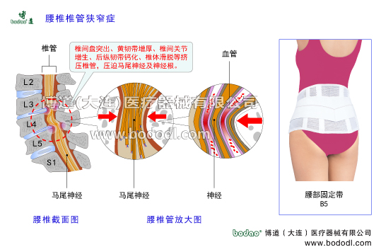 腰椎椎管狹窄癥的主要癥狀與治療博道醫(yī)用護(hù)腰腰部固定帶。腰椎間盤突出、腰椎骨質(zhì)增生、黃韌帶增厚腰椎小關(guān)節(jié)增生椎間關(guān)節(jié)退變關(guān)節(jié)突關(guān)節(jié)不穩(wěn)腰椎滑脫分離腰椎峽部裂等擠壓椎管脊髓馬尾神經(jīng)及腰椎神經(jīng)腰椎軟骨退行性病變腰椎積累性損傷腰椎出血滲出鈣化骨橋?qū)е伦甸g孔狹窄壓迫神經(jīng)根而發(fā)病，導(dǎo)致坐骨神經(jīng)炎。腰肌勞損髓核破裂突出椎間關(guān)節(jié)增生變形引發(fā)馬尾綜合征腰椎固定帶腰椎部主要病癥腰椎管結(jié)構(gòu)解剖圖腰椎小關(guān)節(jié)增生腰骶關(guān)節(jié)勞損