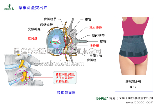 腰椎間盤突出癥的主要癥狀與治療博道醫(yī)用護(hù)腰椎固定帶腰椎退行性改變腰椎勞損髓核破裂突出椎管神經(jīng)根脊神經(jīng)節(jié)交感神經(jīng)馬尾神經(jīng)前縱韌帶后縱韌帶棘間韌帶腰椎椎間關(guān)節(jié)增生椎間盤膨出椎間盤退變馬尾綜合征關(guān)節(jié)突關(guān)節(jié)變形腰肌勞損腰背肌筋膜炎腰椎部及腰骶部軟組織慢性勞損腰椎間盤退化急性腰背肌筋膜損傷腰椎的構(gòu)造解剖圖腰椎小關(guān)節(jié)紊亂腰部固定帶透氣護(hù)腰帶腰圍腰托腰椎矯正固定牽引支具腰椎矯正器腰椎固定支具腰疼帶博道護(hù)腰透氣護(hù)腰