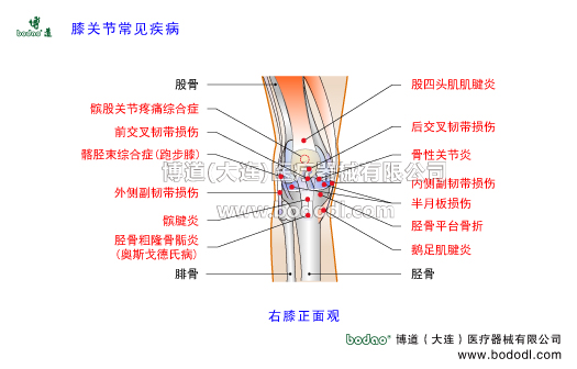 膝關(guān)節(jié)常見疾病及其預(yù)防與治療，膝關(guān)節(jié)半月板損傷，髕前滑囊炎髕腱炎跳躍膝，髕股關(guān)節(jié)炎，博道醫(yī)用膝關(guān)節(jié)固定帶，髕股關(guān)節(jié)綜合證髕骨軟化癥髕骨脫位，膝關(guān)節(jié)滑膜炎骨性關(guān)節(jié)炎滑囊炎，髂脛束綜合征跑步膝，半月板損傷，交叉十字韌帶內(nèi)側(cè)外側(cè)副韌帶損傷，脛股粗隆骨骺病脛骨結(jié)節(jié)軟骨病骨骺炎奧斯戈德氏病生長痛，髕下滑囊炎髕下脂肪墊損傷鵝足肌腱炎右膝正面觀，膝關(guān)節(jié)可調(diào)式卡盤固定護膝支架，膝關(guān)節(jié)置換脛骨平臺骨折髕骨骨折固定支架