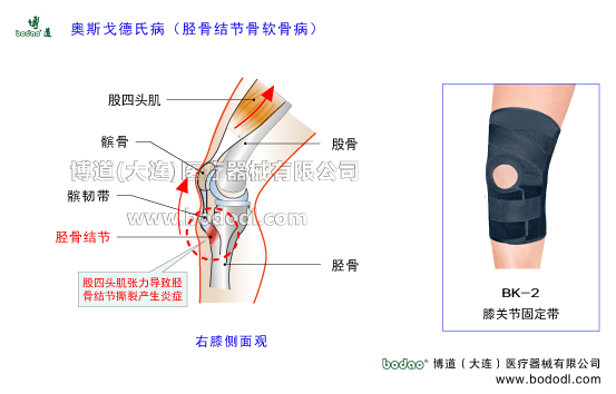 奧斯戈德氏病Osgood-Schlatter病脛骨結(jié)節(jié)骨軟骨病的主要癥狀脛骨粗隆骨骺炎的原因與治療方法癥狀生長痛的原因癥狀與加壓矯正護膝脛骨結(jié)節(jié)軟骨病的癥狀與加壓防護及治療方法脛骨粗隆骨骺炎的癥狀與加壓固定治療跳躍者膝股四頭肌肌腱炎膝關(guān)節(jié)伸膝裝置矯正固定帶膝關(guān)節(jié)固定帶BK-2膝關(guān)節(jié)常見疾病博道運動保暖護膝股四頭肌腱臏腱髕韌帶日本透氣護膝膝關(guān)節(jié)韌帶軟骨損傷矯形固定支具脛骨結(jié)節(jié)骨骺疾病的原因與治療O型腿
