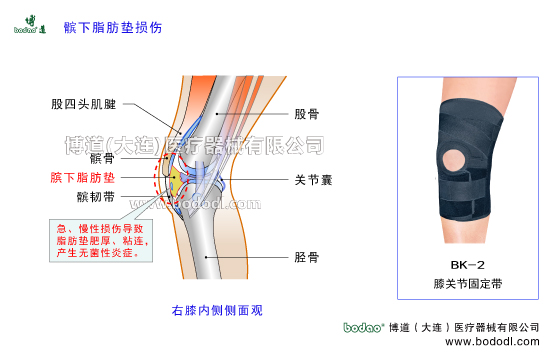 髕下脂肪墊損傷髕下脂肪墊炎Hoffa病脂肪墊勞損脂肪墊損傷，髕下脂肪墊損傷的主要癥狀與康復(fù)治療，博道透氣性醫(yī)用護膝膝關(guān)節(jié)固定帶BK-2，膝關(guān)節(jié)常見疾病，博道戶外運動透氣性加壓護膝排行榜，矯形保暖護膝股骨股四頭肌腱髕骨韌帶損傷臏腱髕韌帶膝關(guān)節(jié)囊膝關(guān)節(jié)軟組織損傷固定支具髕下脂肪墊的形狀和功能膝關(guān)節(jié)囊內(nèi)呈三角形脂肪組織翼狀皺襞。髕下脂肪墊具有加強膝關(guān)節(jié)穩(wěn)定潤滑關(guān)節(jié)組織和減少髕骨髕韌帶與關(guān)節(jié)囊骨關(guān)節(jié)面的摩擦