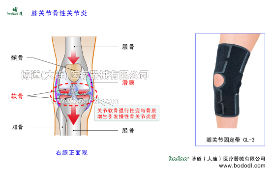 膝關(guān)節(jié)骨性關(guān)節(jié)炎發(fā)病原因OA、Osteoarthrosis膝關(guān)節(jié)退行性關(guān)節(jié)病膝關(guān)節(jié)增生性骨關(guān)節(jié)炎繼發(fā)性膝關(guān)節(jié)骨性關(guān)節(jié)炎和原發(fā)性膝關(guān)節(jié)骨性關(guān)節(jié)炎膝關(guān)節(jié)炎保暖矯形護膝關(guān)節(jié)軟骨防護固定護膝膝關(guān)節(jié)骨質(zhì)增生矯正固定帶膝關(guān)節(jié)慢性關(guān)節(jié)炎矯形固定帶護膝膝關(guān)節(jié)骨性關(guān)節(jié)炎的主要癥狀與治療護理，博道透氣性醫(yī)用護膝排名，膝關(guān)節(jié)固定帶哪家好CL-3膝關(guān)節(jié)常見疾病博道保暖護膝膝關(guān)節(jié)軟骨滑膜膝關(guān)節(jié)囊，日本透氣護膝膝關(guān)節(jié)軟組織損傷
