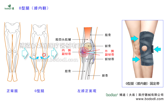 O型腿羅圈腿膝內(nèi)翻下肢畸形疾病。膝關(guān)節(jié)的構(gòu)造，O型腿膝內(nèi)翻的病因、癥狀及治療方法。O型腿膝內(nèi)翻的危害與預(yù)防治療。O型腿膝內(nèi)翻的保守治療與手術(shù)治療及康復(fù)護理。膝關(guān)節(jié)退行性骨性關(guān)節(jié)炎。博道O型腿膝內(nèi)翻專用透氣性醫(yī)用護膝排名，膝關(guān)節(jié)加壓固定帶矯形保暖護膝日本透氣護膝膝關(guān)節(jié)固定矯形支架膝關(guān)節(jié)內(nèi)側(cè)半月板內(nèi)側(cè)副韌帶，膝關(guān)節(jié)外側(cè)半月板外側(cè)副韌帶的矯正固定。女性O(shè)型腿膝內(nèi)翻患病率多于男性的原因。
