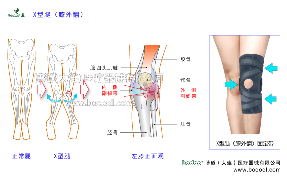 X型腿膝外翻下肢畸形疾病。膝關(guān)節(jié)的構(gòu)造，X型腿膝外翻的發(fā)病原因、癥狀及治療方法。X型腿膝外翻的危害與治療方法。X型腿膝外翻的保守治療與手術(shù)治療及康復(fù)護理。膝關(guān)節(jié)退行性骨性關(guān)節(jié)炎。博道X型腿膝外翻專用加壓矯形護膝，膝關(guān)節(jié)加壓固定帶矯形保暖護膝日本透氣護膝膝關(guān)節(jié)固定矯形支架膝關(guān)節(jié)內(nèi)側(cè)半月板內(nèi)側(cè)副韌帶的矯正固定，膝關(guān)節(jié)外側(cè)半月板外側(cè)副韌帶的矯正固定。女性X型腿膝外翻患病率多于男性的原因。