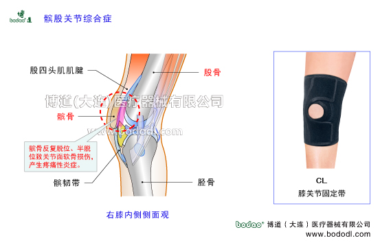 髕股關(guān)節(jié)疼痛綜合癥的病因及癥狀PFPS髕骨軟化癥專用加壓護膝髕骨脫位膝關(guān)節(jié)退行性關(guān)節(jié)病膝關(guān)節(jié)增生性骨關(guān)節(jié)炎博道透氣性膝關(guān)節(jié)固定帶CL-1膝關(guān)節(jié)常見疾病矯形保暖護膝膝關(guān)節(jié)軟骨髕韌帶股四頭肌腱右膝側(cè)面觀膝關(guān)節(jié)矯正帶髕股關(guān)節(jié)主要功能是確保膝關(guān)節(jié)屈伸時髕骨在股骨髁間切跡中上下滑動完成屈伸跳躍等動作髕股關(guān)節(jié)的穩(wěn)定性主要依靠股四頭肌腱髕骨髂脛束和股內(nèi)側(cè)斜肌的動力性因素也依靠膝關(guān)節(jié)囊股骨髁髕骨內(nèi)外側(cè)支持帶和臏股韌
