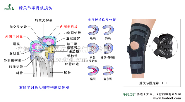膝關(guān)節(jié)半月板損傷膝關(guān)節(jié)半月板及韌帶構(gòu)造。膝關(guān)節(jié)韌帶半月板關(guān)節(jié)囊滑膜骨骼解剖圖。半月板損傷分型。博道膝關(guān)節(jié)可調(diào)節(jié)式卡盤固定支架膝關(guān)節(jié)骨折可調(diào)式固定支架CL-H內(nèi)側(cè)半月板外側(cè)半月板及韌帶構(gòu)造髕韌帶髕下脂肪墊翼狀皺襞髕下滑膜皺襞脛骨粗隆脛骨外側(cè)副韌帶腘肌腱腓骨膝橫韌帶后交叉韌帶內(nèi)側(cè)副韌帶膝關(guān)節(jié)囊膝關(guān)節(jié)滑膜前交叉韌帶半月板損傷的原因、癥狀及治療方法。可調(diào)式膝關(guān)節(jié)固定帶腿部下肢骨折固定夾板半月板損傷的主要癥狀