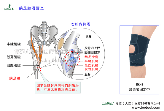 鵝足腱滑囊炎。鵝足肌腱炎的病因、癥狀與防護治療。蛙泳膝與脛骨內(nèi)髁炎因肌腱過度使用癥候群，鵝足腱加壓固定帶博道醫(yī)用護膝，鵝足腱滑囊炎專用護膝，鵝足腱的構(gòu)造，膝關(guān)節(jié)固定帶BK-3透氣性加壓護膝。鵝足腱由縫匠肌腱股薄肌腱半腱肌腱組成，止于膝下脛骨內(nèi)側(cè)因形同鵝足而得名具有防止下肢行走跑步時的外向旋轉(zhuǎn)功能。鵝足腱滑囊是封閉性囊，不與膝關(guān)節(jié)相通，在膝關(guān)節(jié)11個滑囊中位置特殊具有減少肌腱組織摩擦增加滑動的作用