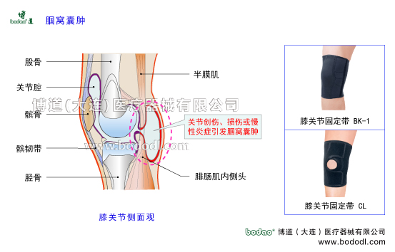 腘窩囊腫，貝克囊、Baker\'s cyst膝關(guān)節(jié)構(gòu)造，膝關(guān)節(jié)腔的結(jié)構(gòu)，股骨脛骨髕骨的構(gòu)造，博道醫(yī)用膝關(guān)節(jié)固定帶BK-1、CL-1透氣性醫(yī)用加壓護膝的防護效果，腘窩囊腫的病因、癥狀及康復(fù)治療與護理，腘窩囊腫加壓固定帶，膝關(guān)節(jié)角度可調(diào)式卡盤固定支架半月板損傷固定支具戶外運動加壓護膝，膝蓋骨折固定夾板日本透氣護膝，膝關(guān)節(jié)韌帶軟骨等軟組織損傷康復(fù)固定夾板，下肢腿部術(shù)后固定夾板，股骨髕骨脛骨腓骨骨折專業(yè)固定夾