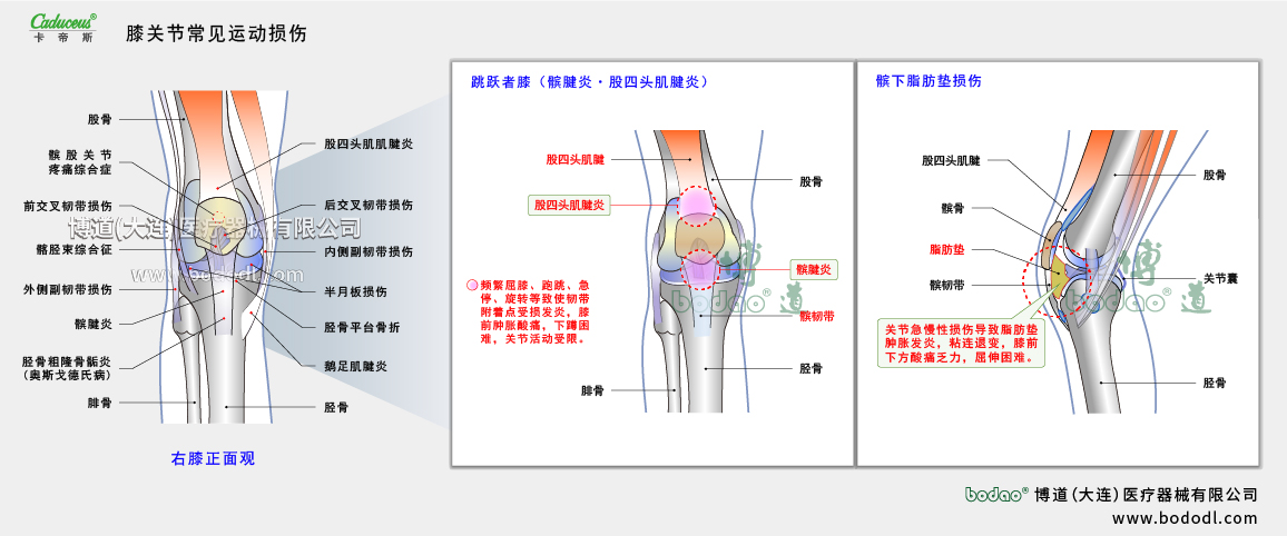 膝關(guān)節(jié)運動損傷的類型與癥狀