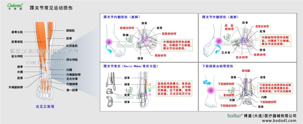 踝關(guān)節(jié)運動損傷的類型與癥狀