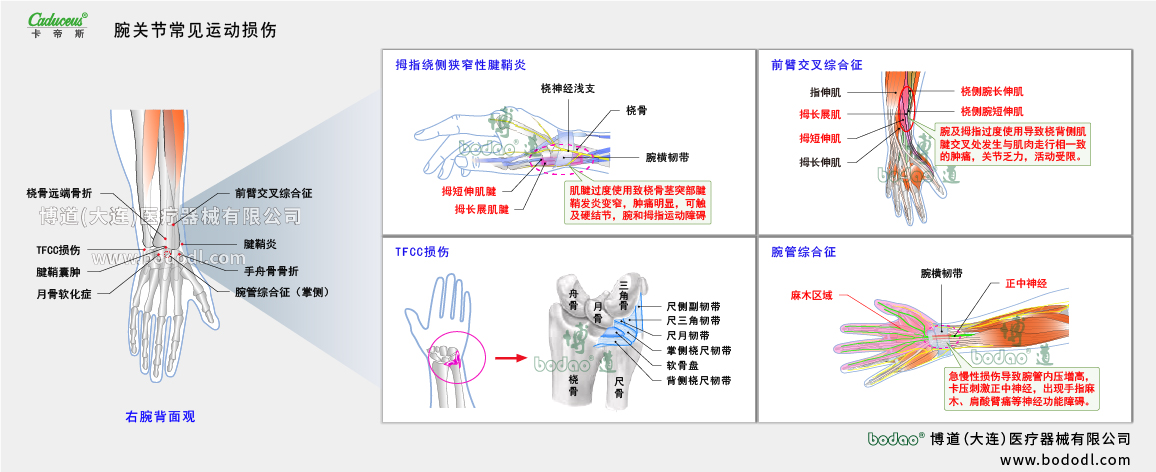 腕關節(jié)運動損傷的類型與癥狀