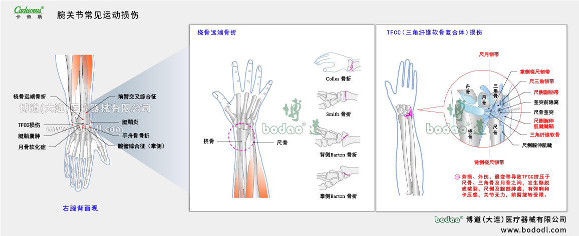 腕關(guān)節(jié)運(yùn)動(dòng)損傷的類型與癥狀