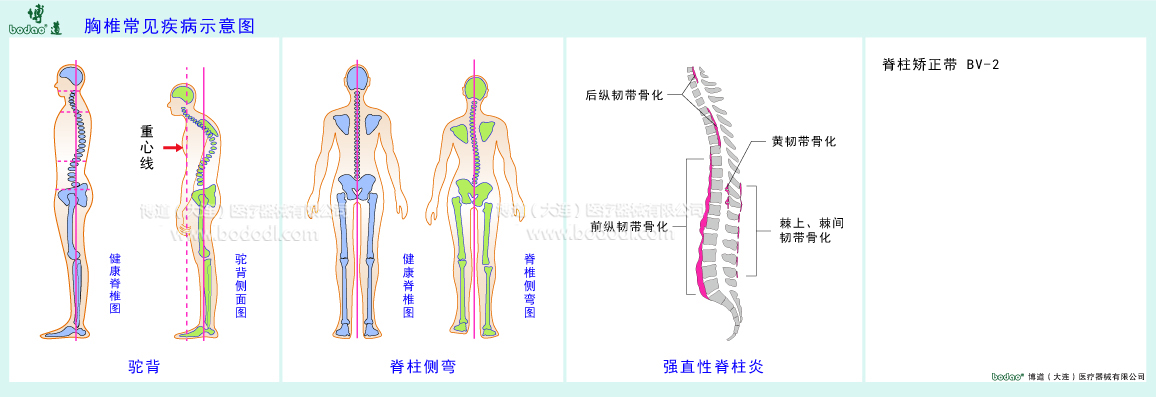 胸椎常見(jiàn)疾病示意圖