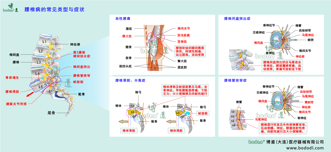 腰椎病的類型與癥狀