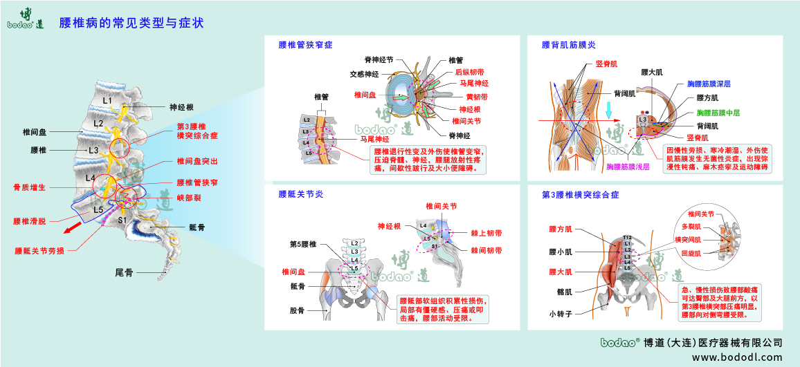 腰椎病的類(lèi)型與癥狀