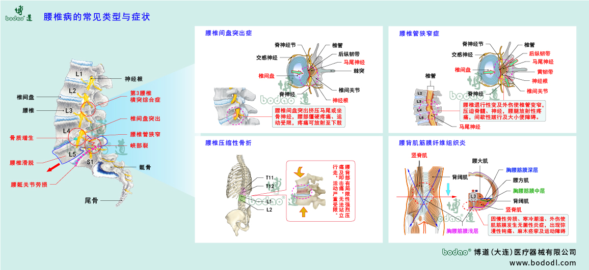 腰椎病的類型與癥狀