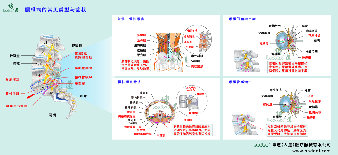 腰椎病的類(lèi)型與癥狀
