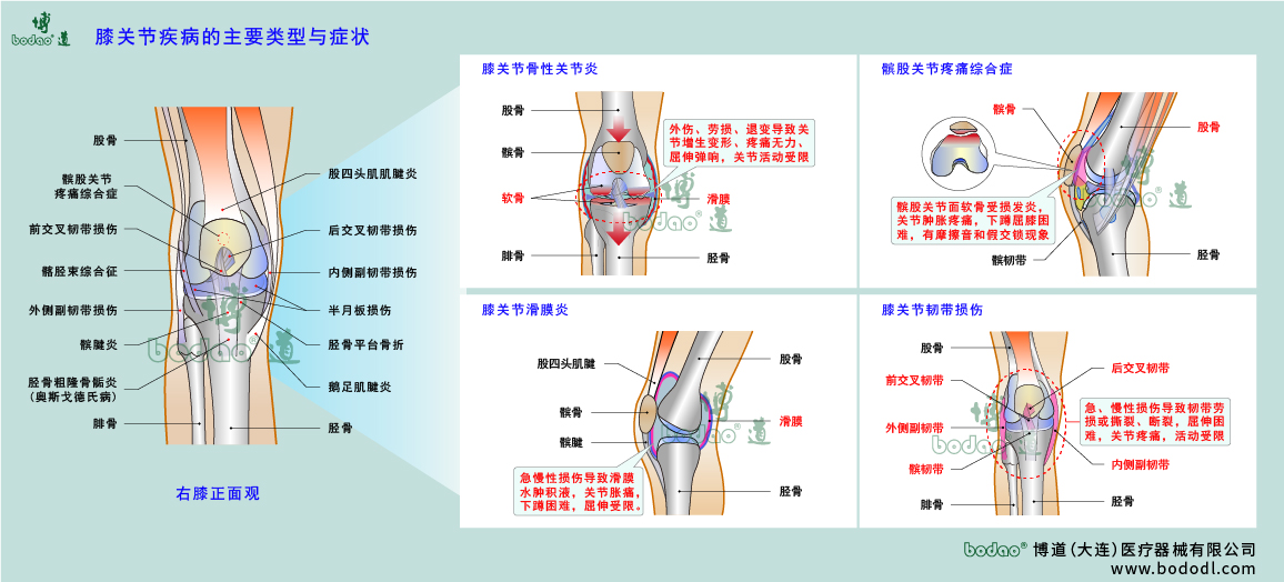膝關(guān)節(jié)疾病的類型與癥狀