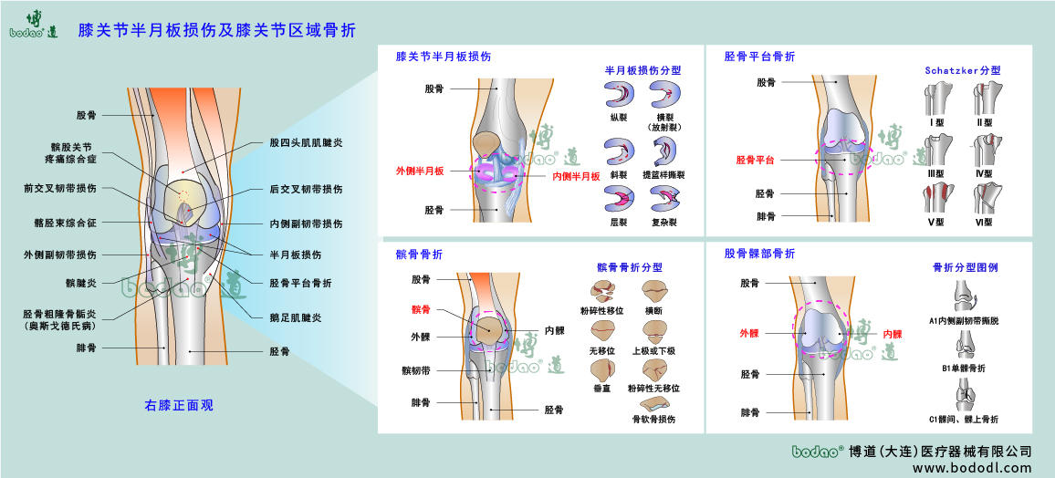 膝關(guān)節(jié)疾病的類型與癥狀