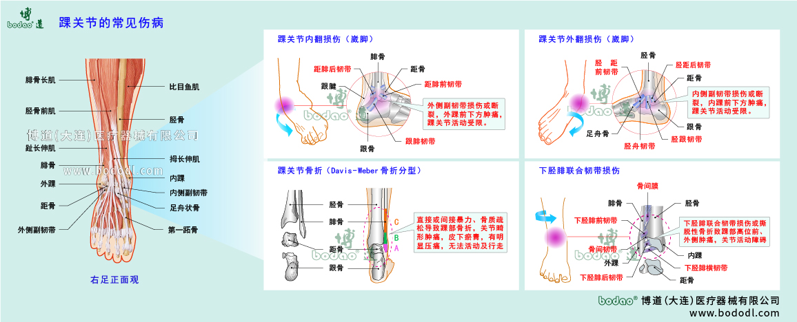 踝關節(jié)傷病的類型與癥狀