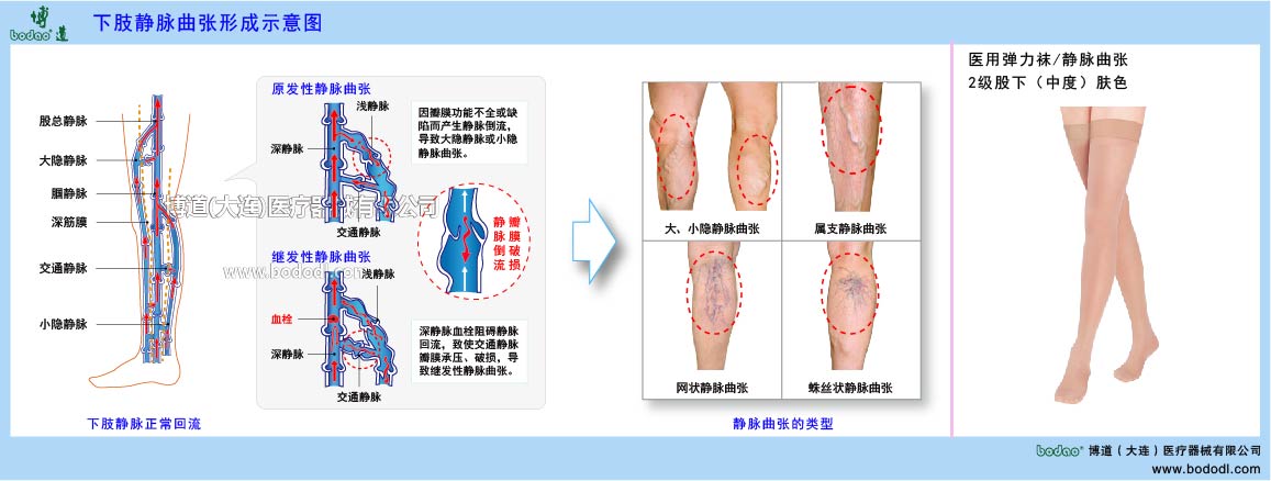 下肢靜脈曲張與健康防護