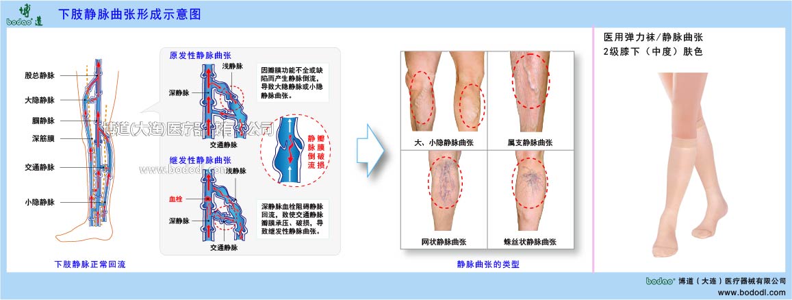 下肢靜脈曲張與健康防護(hù)