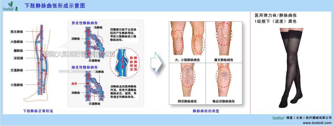 下肢靜脈曲張與健康防護
