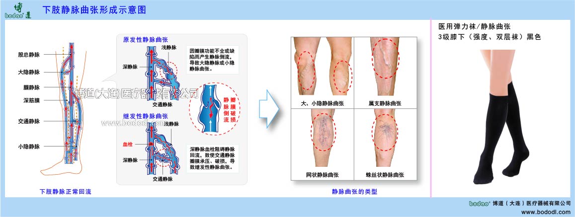 下肢靜脈曲張與健康防護