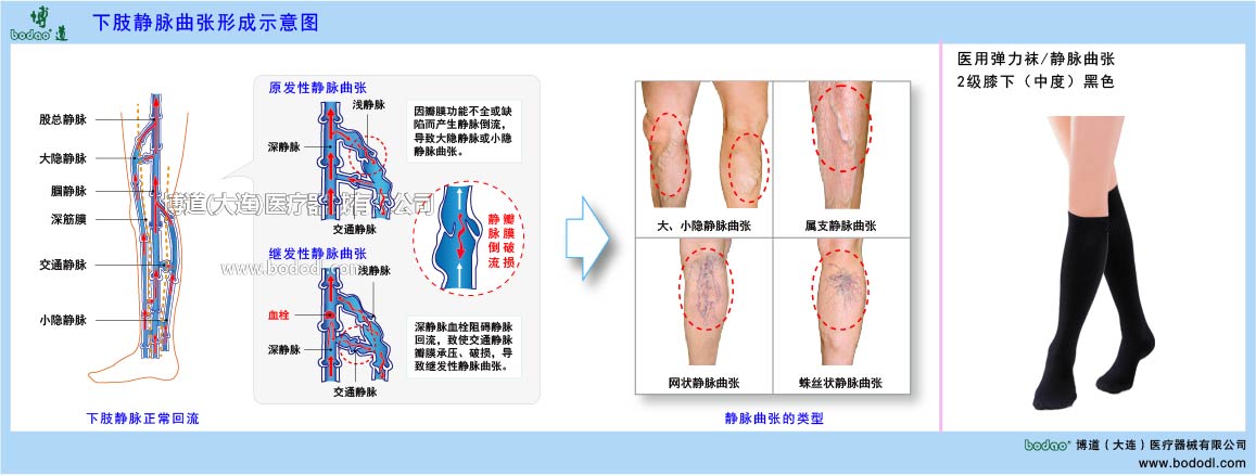 下肢靜脈曲張與健康防護(hù)