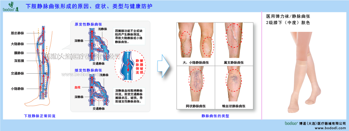 下肢靜脈曲張與健康防護(hù)