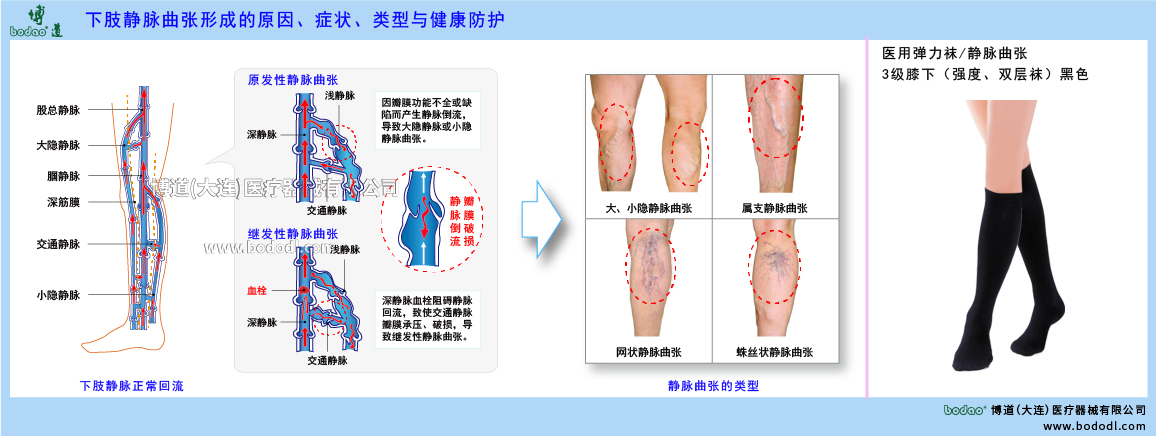 下肢靜脈曲張與健康防護